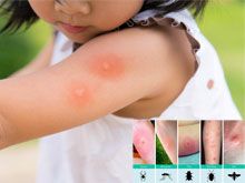 《自然療法與你》- EP659 - 蚊蟲叮咬的同類療法
